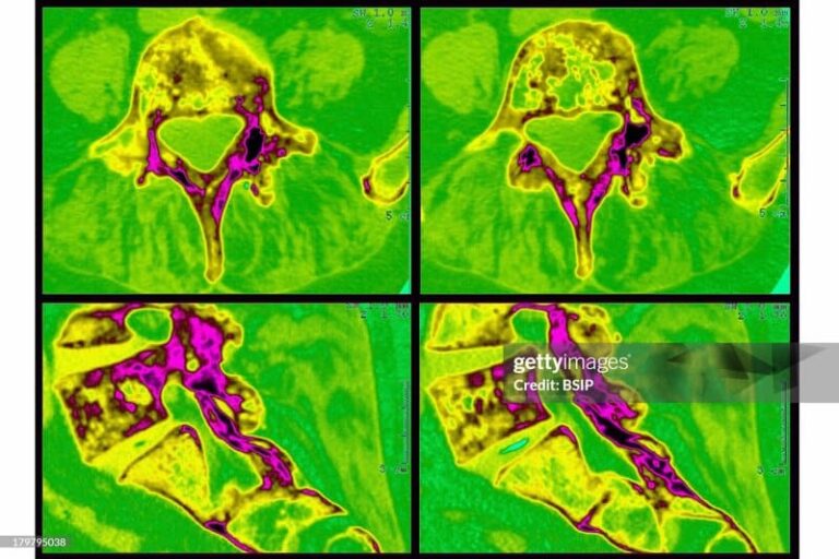 Paget’s disease