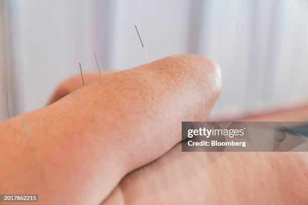 acupuncture