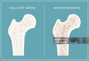 Osteoporosis, osteopathic, bone health, symptoms of osteoporosis, health, well being, bone, exercise