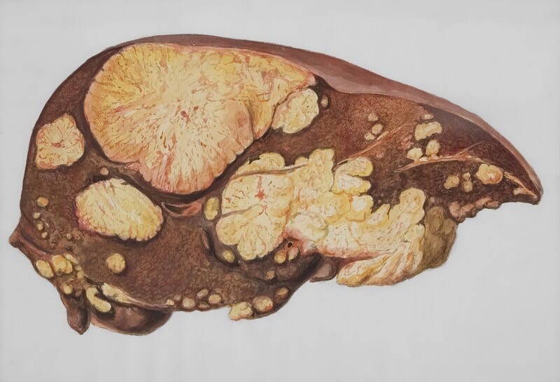 cirrhosis of the liver.