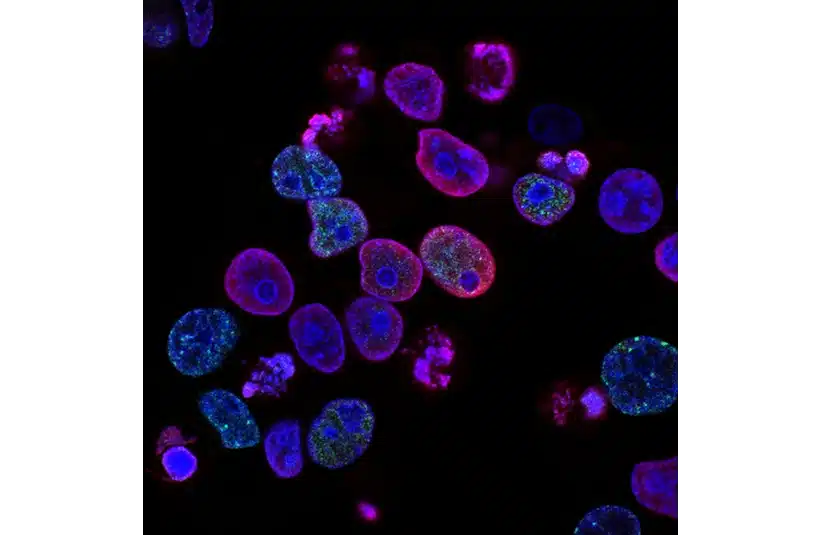 Image of Human colorectal cancer cells treated with a topoisomerase inhibitor and an inhibitor of the protein kinase ATR
